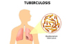 DK has identified 18 TB cases